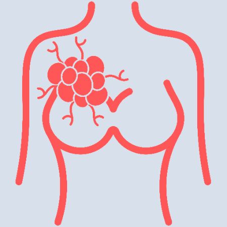 Breast Cancer Breast Cancer