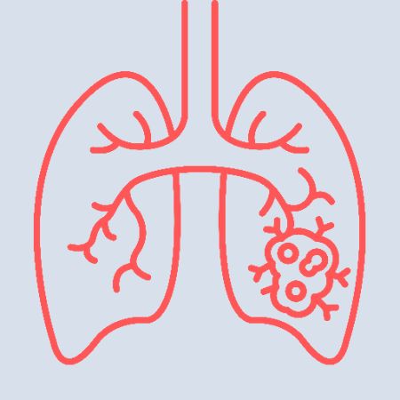 Lung Cancer Lung Cancer